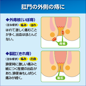プリザエース軟膏は、肛門の外側の痔の症状に