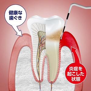 歯周病は、歯肉炎・歯槽膿漏の総称です。