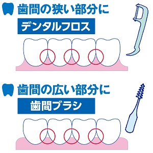 ◆歯間の狭い部分にはフロス、広い部分には歯間ブラシを